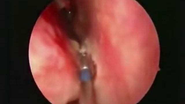 рассечение синехии визаром смотреть онлайн