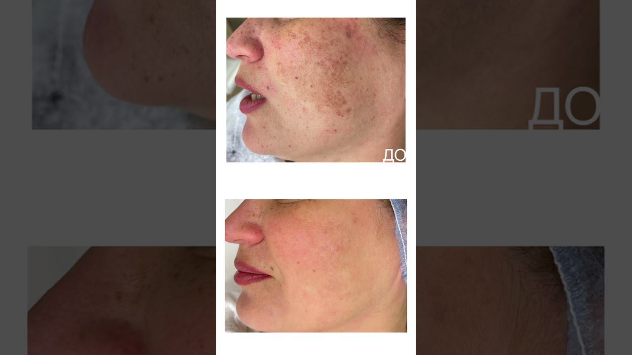 Лечение пигментации смотреть онлайн