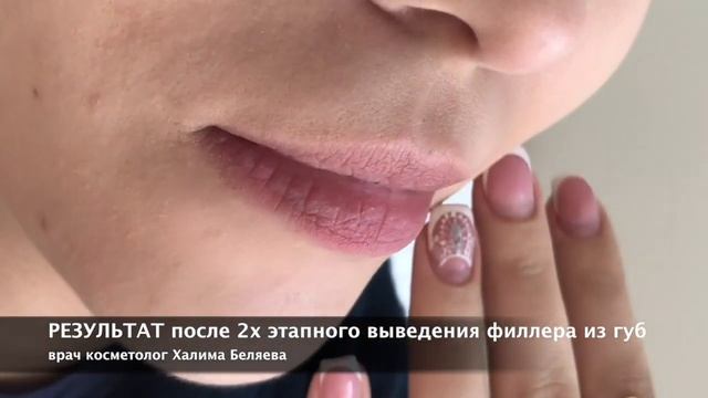 Лидаза. Удаление филлера из губ. смотреть онлайн