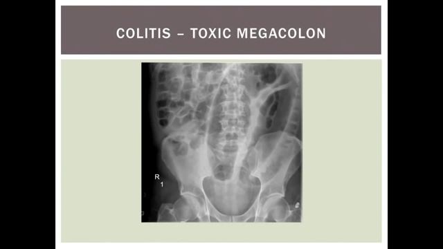 Everything you need to know about abdominal x-rays in 5 minutes смотреть онлайн