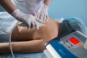 Карбокситерапия