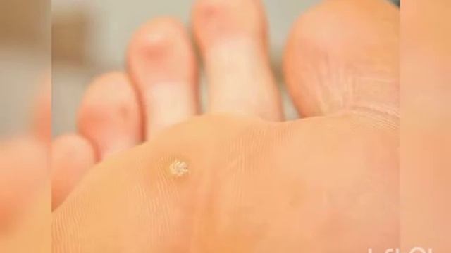 Бородавка ва папиллома давоси ЧИСТОТЕЛЬ ёки СКАЛЬПЕЛЬ? Кандай даволаш мумкин бир суткада? смотреть онлайн