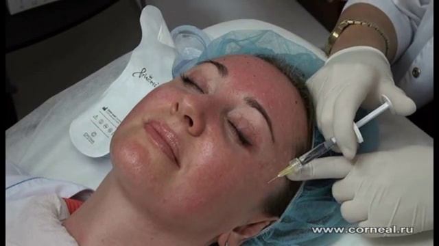 Заполнять морщины нестабилизированной гиалуронкой бессмысленно