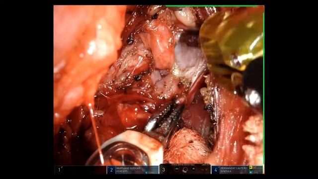 TORS- Retropharyngeal Lymph Node Dissection смотреть онлайн