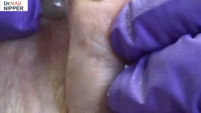 What Are Horseshoe Toenails?  Dr Nail Nipper  (2021)