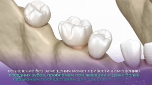 Остался только корень зуба! Что делать и как лучше восстановить?