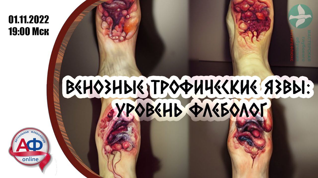 Венозные трофические язвы: уровень флеболог смотреть онлайн