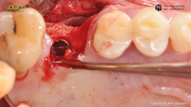 Lateral Sinus Lift With Implant Placement Case - OraAid