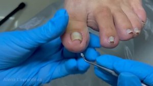 Скрученный ноготь / установка титановой нити / врос на большом пальце / Подология /