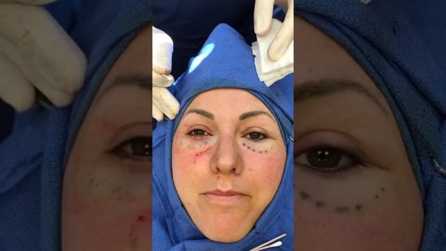 Lower Blepharoplasty and Belaflil Filler Removal смотреть онлайн