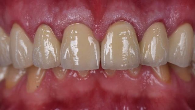 Реставрация зубов металлокерамическими коронками