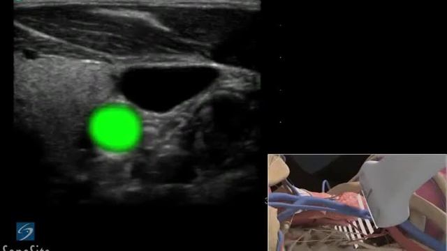 3D-пособие: Катетеризация внутренней яремной вены под контролем ультразвука с продольным доступом смотреть онлайн