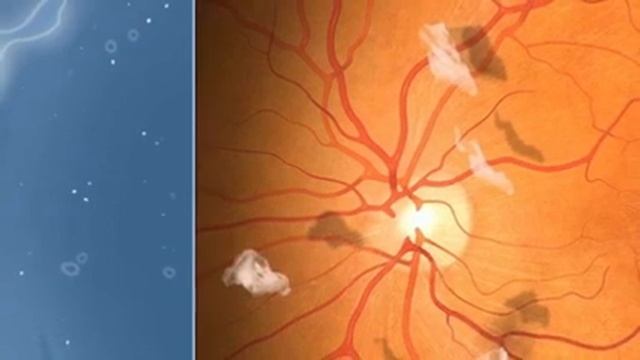 Плавающие Мушки Перед Глазами - Степени, Формы, Типы, Стадии, Симптомы(Вспышки, Визуальный Снег) ДС смотреть онлайн