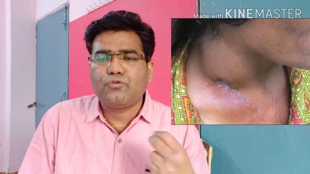 Causes of Enlarged Cervical lymphnode? its Treatment in Hindi | (Gale Me Gilti Ki Dawa) смотреть онлайн