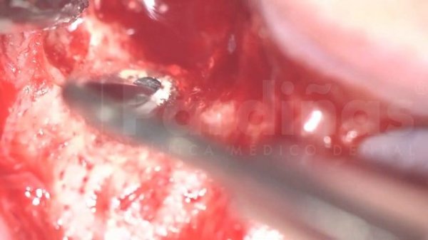 Apicoectomy surgery - Live procedure step by step