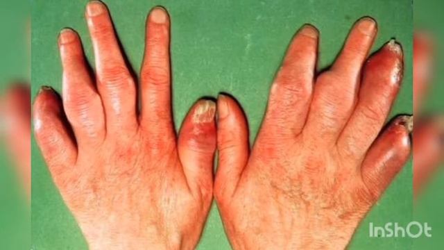 РЕЦЕПТЫ ЛЕЧЕБНОЙ ДИЕТЫ ПРИ ПСОРИАЗЕ ОТ КАНАЛА***SUPERTRAVNIK***В МОИХ КОМЕНТАРИЯХ смотреть онлайн