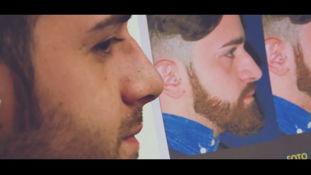 Rinoplasty a Milano. La storia di Giuseppe. Rhinoplasty in Milan. The story of GIUSEPPE. смотреть онлайн