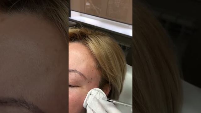 Инъекции Ботокса Вокруг Глаз в Краснодаре