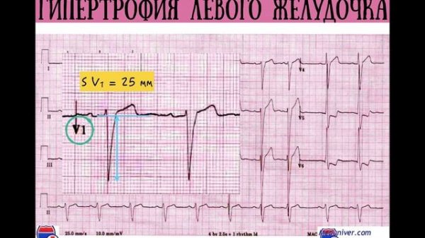 Расшифровка ЭКГ при гипертрофии желудочков