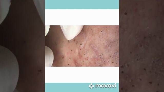 ЧИСТИМ ЧЁРНЫЕ ТОЧКИ ПИНЦЕТОМ|WE CLEAN THE BLACK DOTS WITH TWEEZERS смотреть онлайн