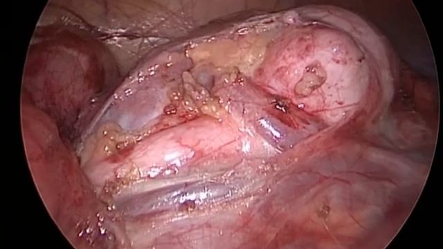 Гидронефроз подковообразной почки у ребенка. смотреть онлайн