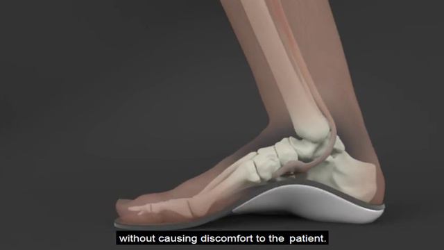 Sole Supports MASS Posture Orthotics: Calibrated Leaf Springs and the Gait Cycle смотреть онлайн