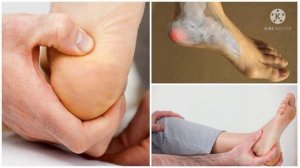 шпоры. шпоры на пятках. как избавиться от шпор на пятках