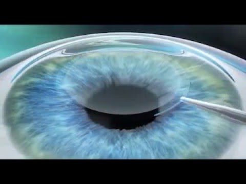 Бесконтактная коррекция зрения. Фемтолазер VisuMax смотреть онлайн