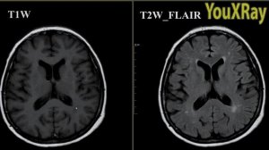 Базовые лекции по МРТ / МР-последовательности: разница  между T1W и T2W FLAIR изображениями