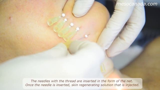 Thread Lifting 4D (Mesotherapy) смотреть онлайн