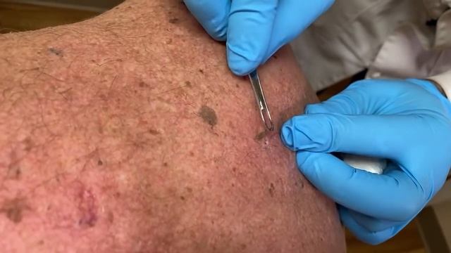 Live Blackheads | Auburn Medical Group