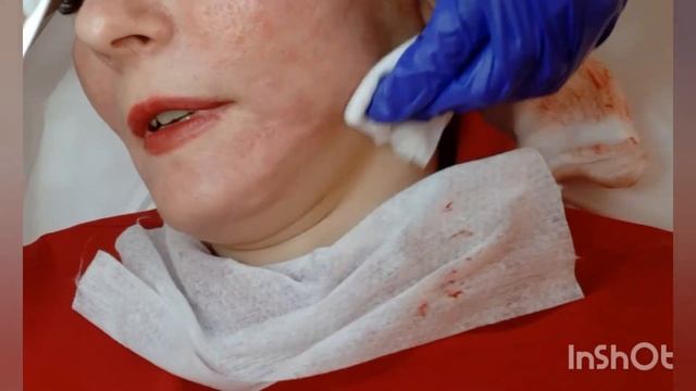 МЕЗОТЕРАРИЯ . КРАТКИЙ ОБЗОР // РЕКОМЕНДАЦИИ И СОВЕТЫ БИОРЕВИТАЛИЩАЦИЯ ИЛИ МЕЗОТЕРАРИЯ / МОЁ МНЕНИЕ смотреть онлайн