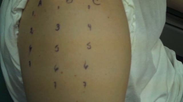 Allergy Testing Step 2, Modified Quantitative Testing