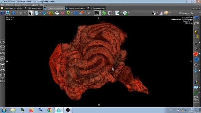 МСКТ БП . РАЗБОР ПАТОЛОГИЙ В ЖКТ . смотреть онлайн