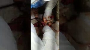 тотал гистерэктомия 1 часть,опер Бакиров Бекмурод,Андижан Шахрихан 1- роддом