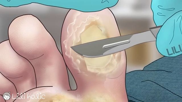 Satisfying! foot wart treatment | screw nail removal | tingle sound смотреть онлайн