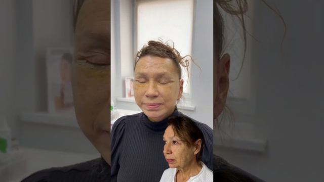 Всего 4 сутки после фейслифтинга! смотреть онлайн