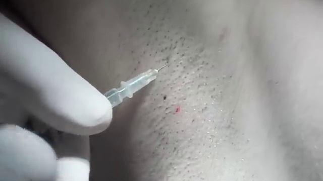 IPERIDROSI ASCELLARE BOTULINO PROF. FRANCESCO BRUNO .AVI смотреть онлайн