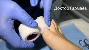 Перевязка после удаления вросшего ногтя