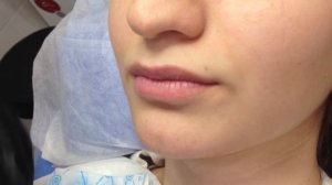 Обучение Выкладываем контур губ филлером