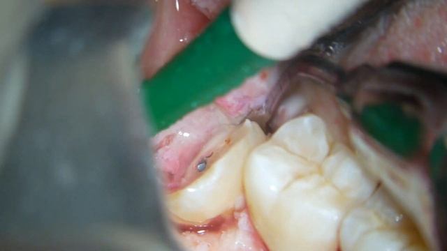 curved apex wisdom tooth extraction смотреть онлайн