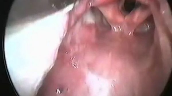 Интубация трахеи