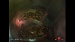 Лазерная вапоризация дисплазии шейки матки на аппарате ЛАХТА МИЛОН. Минкевич К.В.