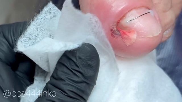 Гранулёма / паронихия / вросший ноготь смотреть онлайн