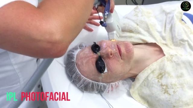 IPL PHOTOFACIAL – SKIN REJUVENATION смотреть онлайн