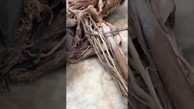 Анатомия - шейное, плечевое сплетение смотреть онлайн