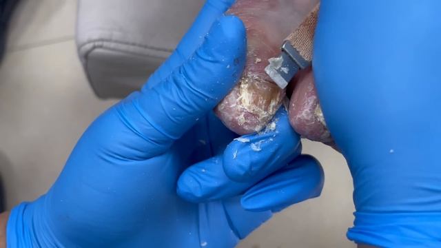 Pedicure Tutorial：Very Chunky Nail Fungus!【Pedicure Master Lin Jun】