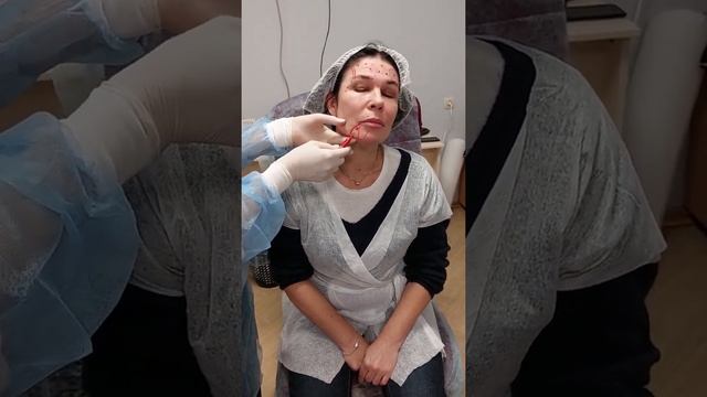 Ботулинотерапия разметка Full face смотреть онлайн