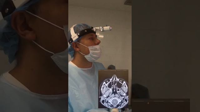 Хронический гайморит.Грибок в пазухе носа. Стомат.материал в пазухе. #ЛОРврачГоровой #лор #гайморит смотреть онлайн