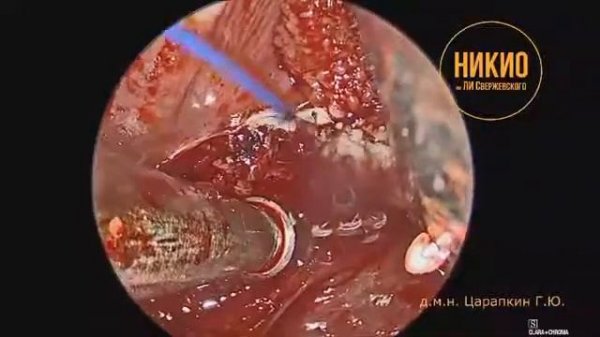 Удаление миндалин лазером Wolf TruBlue